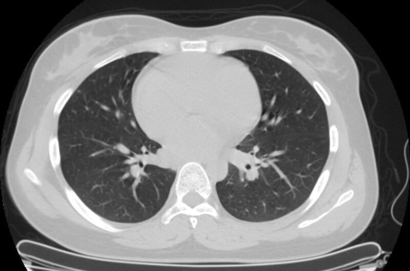 File:Cannonball metastases - uterine choriocarcinoma (Radiopaedia 70137-80173 Axial lung window 59).jpg
