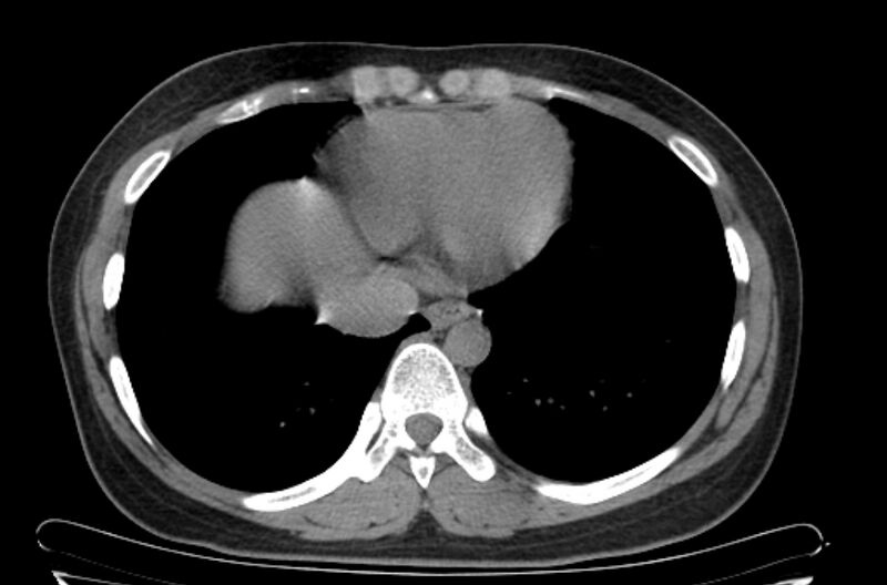 File:Cannonball metastases - uterine choriocarcinoma (Radiopaedia 70137-80173 Axial non-contrast 92).jpg