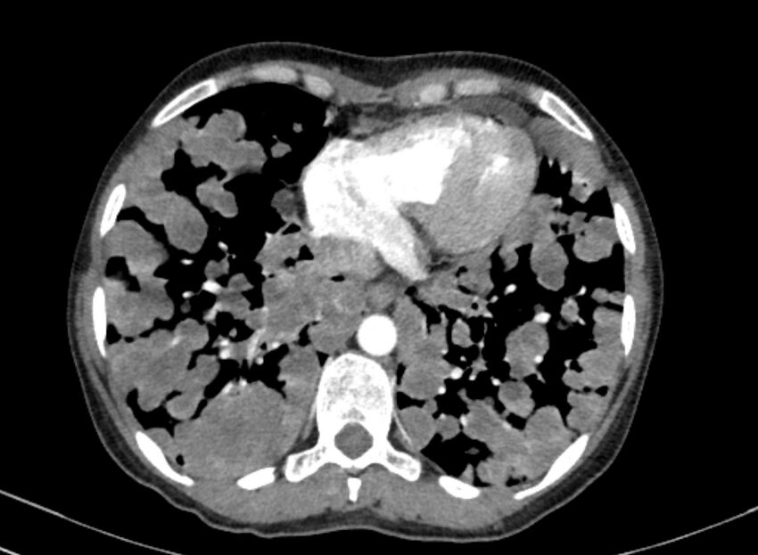 Cannonball metastases from breast cancer (Radiopaedia 91024-108569 A 90).jpg