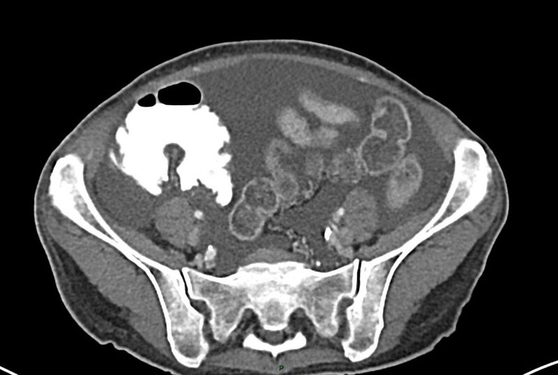 File:Carcinoid mesenteric tumor complicated by chylous ascites (Radiopaedia 76312-87953 A 56).jpg