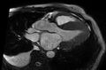 Cardiac amyloidosis (Radiopaedia 61600-69579 B 12).jpg