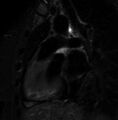 Cardiac sarcoidosis (Radiopaedia 74548-85466 2ch STIR 7).jpg