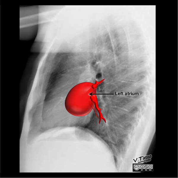 File:Cardiomediastinal anatomy on chest radiography (annotated images) (Radiopaedia 46331-50772 J 1).png