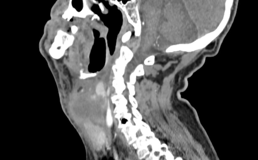 Carotid artery pseudoaneurysm (Radiopaedia 84030-99259 E 15).jpg