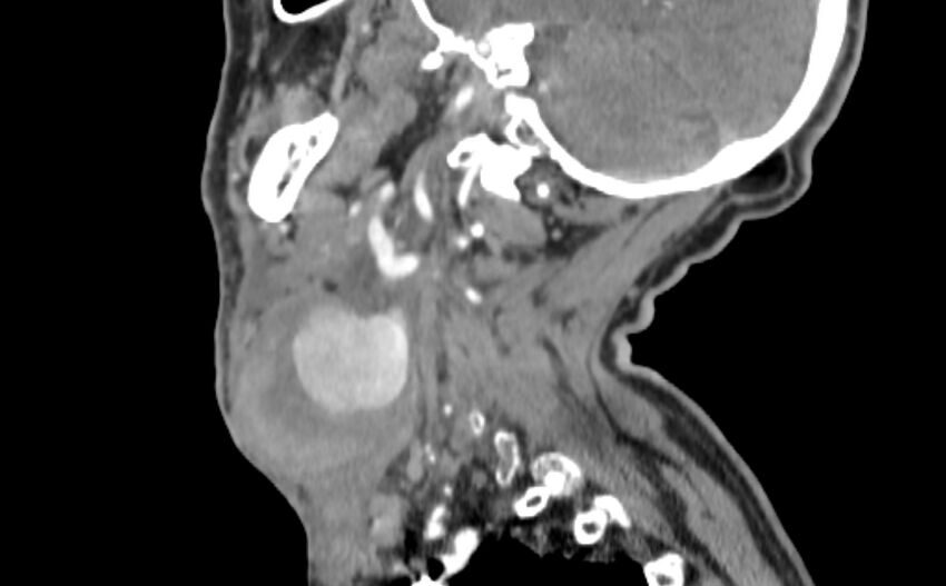 Carotid artery pseudoaneurysm (Radiopaedia 84030-99259 E 32).jpg