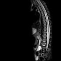 Caudal regression syndrome (Radiopaedia 61990-70072 Sagittal T2 TIRM 5).jpg