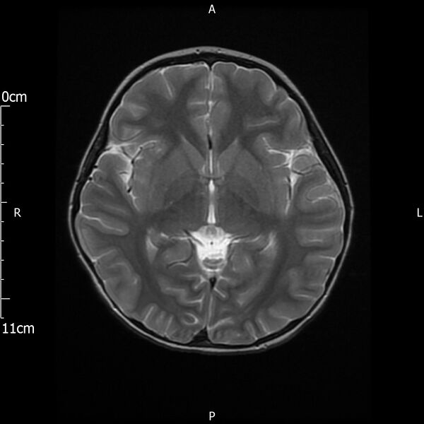 File:Cavernous sinus thrombosis (Radiopaedia 79414-92512 Axial T2 15).jpg