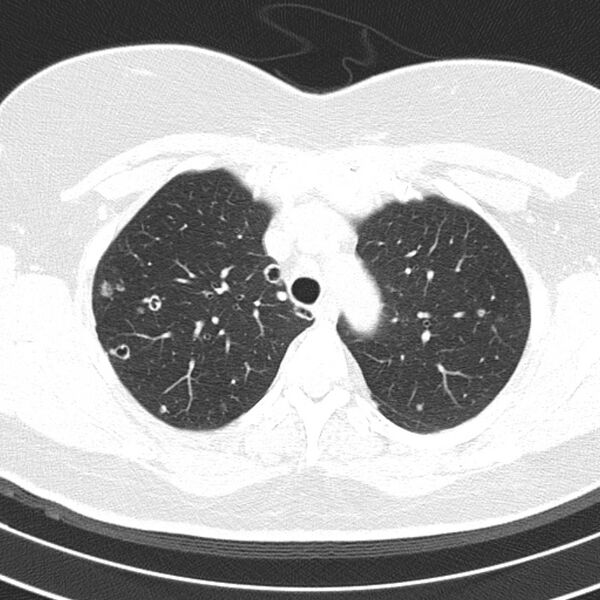 File:Cavitating pulmonary metastases (Radiopaedia 17796-17555 Axial lung window 3).jpg