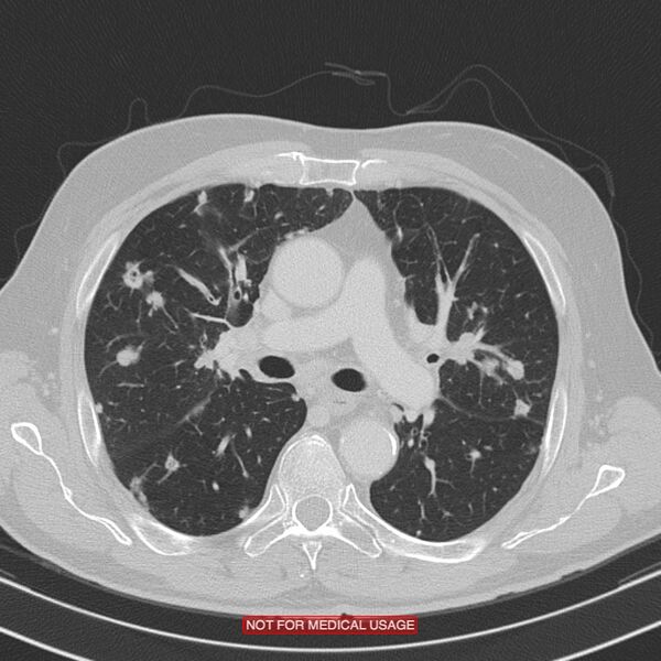 File:Cavitating pulmonary metastases (Radiopaedia 24920-25184 Axial lung window 9).jpg