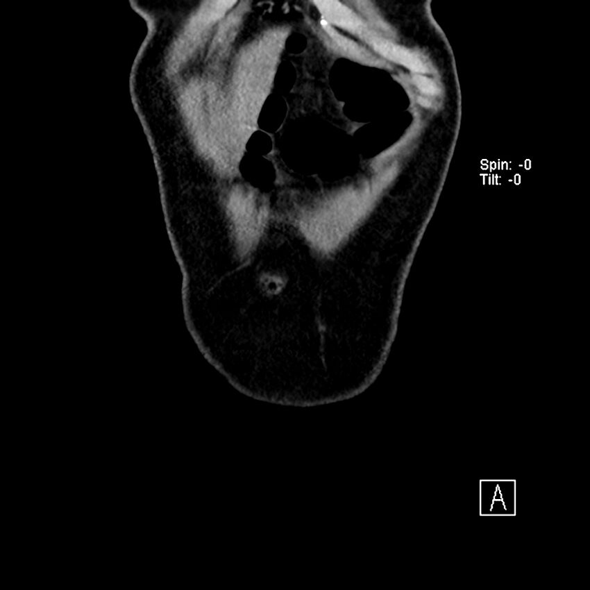Cecal volvulus (Radiopaedia 90897-108397 Coronal non-contrast 56).jpg