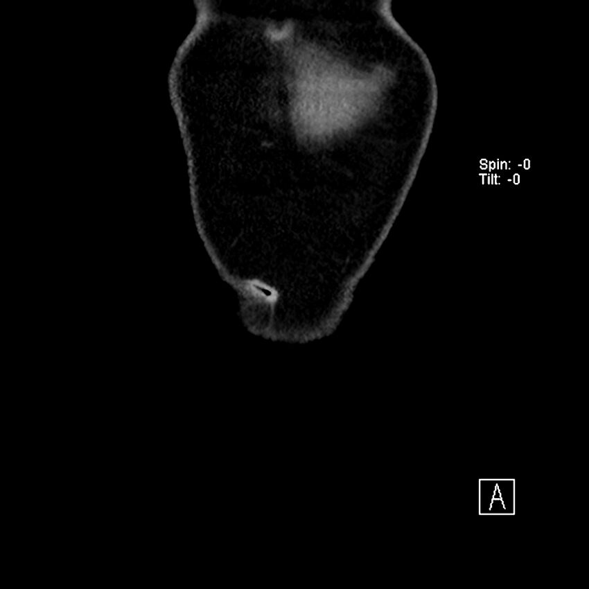 Cecal volvulus (Radiopaedia 90897-108397 Coronal non-contrast 59).jpg