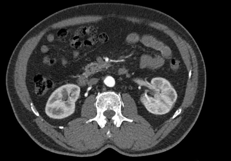 File:Celiac artery dissection (Radiopaedia 52194-58080 A 46).jpg