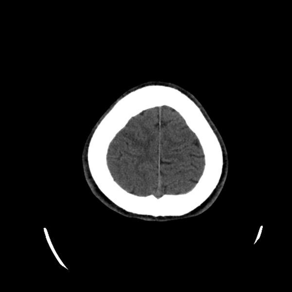 File:Central neurocytoma (Radiopaedia 79320-92379 Axial non-contrast 38).jpg