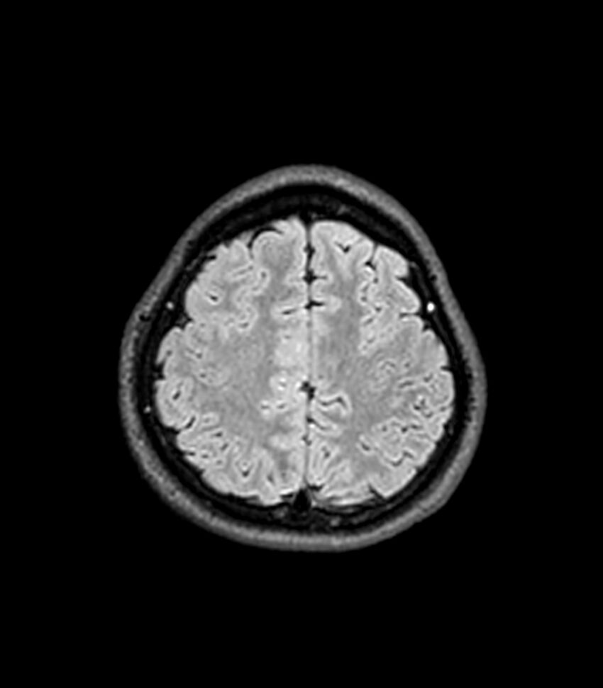 Central neurocytoma (Radiopaedia 79320-92380 Axial FLAIR 75).jpg