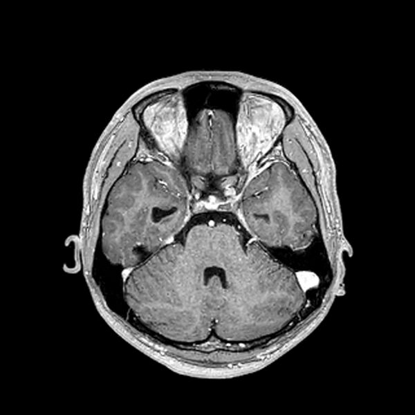File:Central neurocytoma (Radiopaedia 79320-92380 Axial T1 C+ 88).jpg