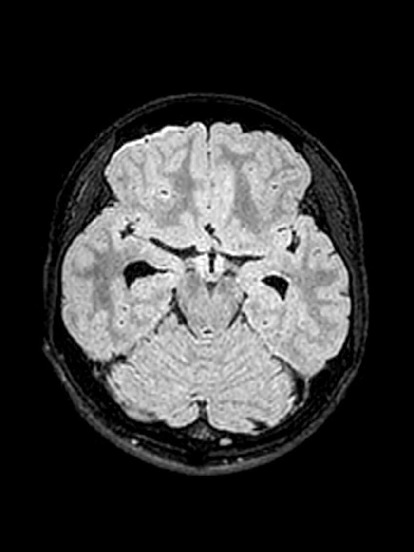 Central neurocytoma (Radiopaedia 79320-92381 Axial FLAIR 107).jpg