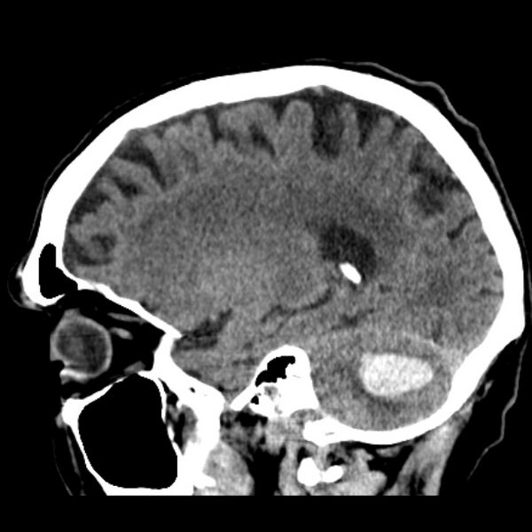 File:Cerebellar hemorrhage (Radiopaedia 27193-27359 C 30).jpg