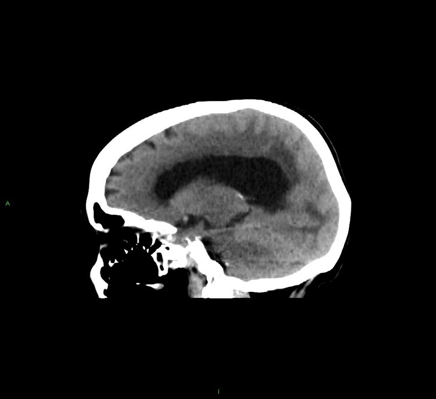 Cerebellar hemorrhage (Radiopaedia 58793-66027 C 32).jpg