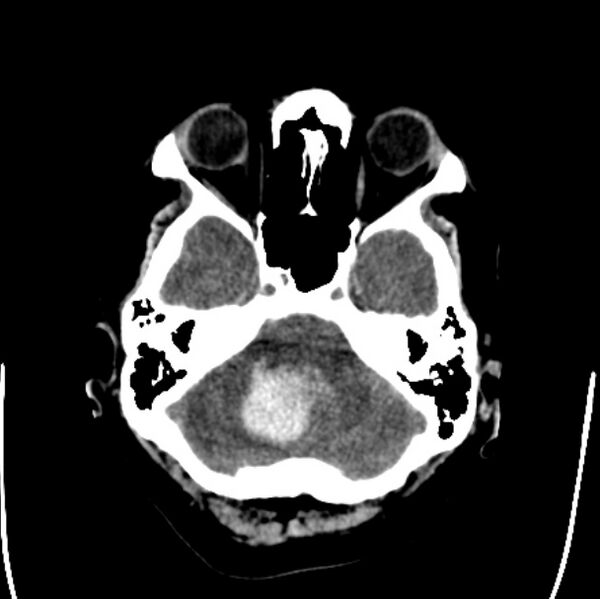File:Cerebellar hemorrhage causing obstructive hydrocephalus (Radiopaedia 33989-35207 Axial non-contrast 10).jpg
