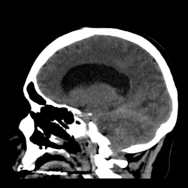 File:Cerebellar hemorrhage causing obstructive hydrocephalus (Radiopaedia 33989-35207 B 29).jpg