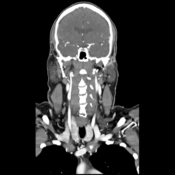 File:Cerebellar infarct due to vertebral artery dissection with posterior fossa decompression (Radiopaedia 82779-97029 D 27).png