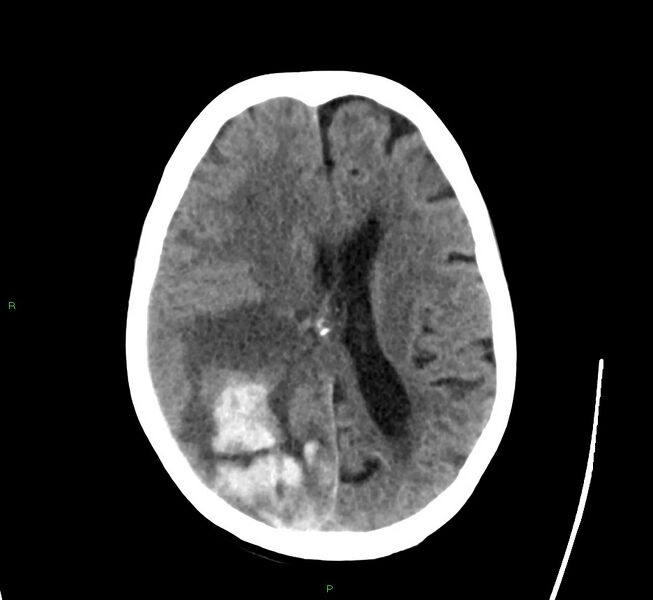 File:Cerebral amyloid angiopathy-associated lobar intracerebral hemorrhage (Radiopaedia 58563-65727 Axial non-contrast 24).jpg