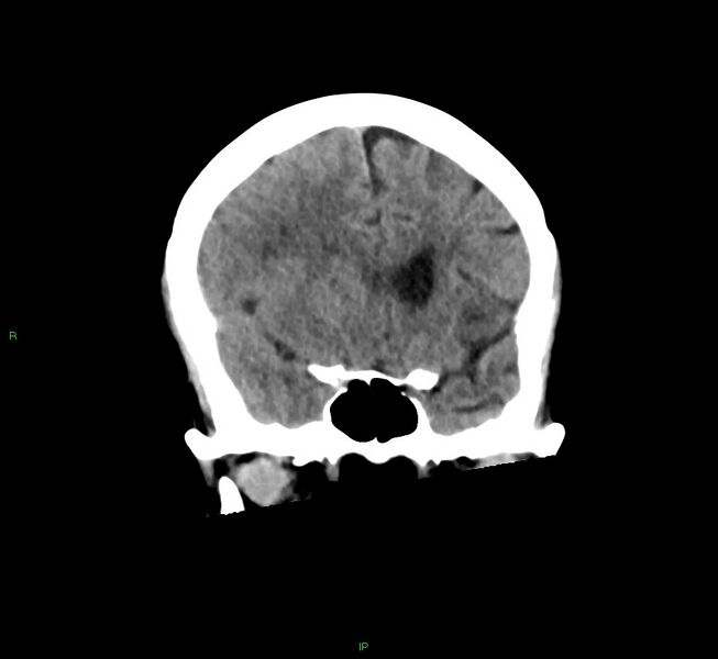 File:Cerebral amyloid angiopathy-associated lobar intracerebral hemorrhage (Radiopaedia 58563-65727 Coronal non-contrast 44).jpg