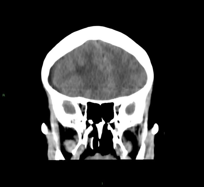 File:Cerebral amyloid angiopathy-associated lobar intracerebral hemorrhage (Radiopaedia 58751-65972 Coronal non-contrast 44).jpg