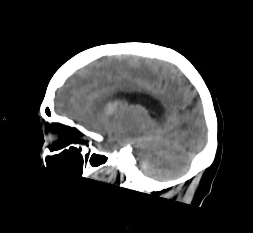 Cerebral amyloid angiopathy-associated lobar intracerebral hemorrhage (Radiopaedia 58752-65973 C 22).jpg