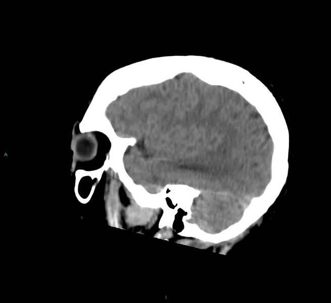 File:Cerebral amyloid angiopathy-associated lobar intracerebral hemorrhage (Radiopaedia 58756-65977 C 44).jpg