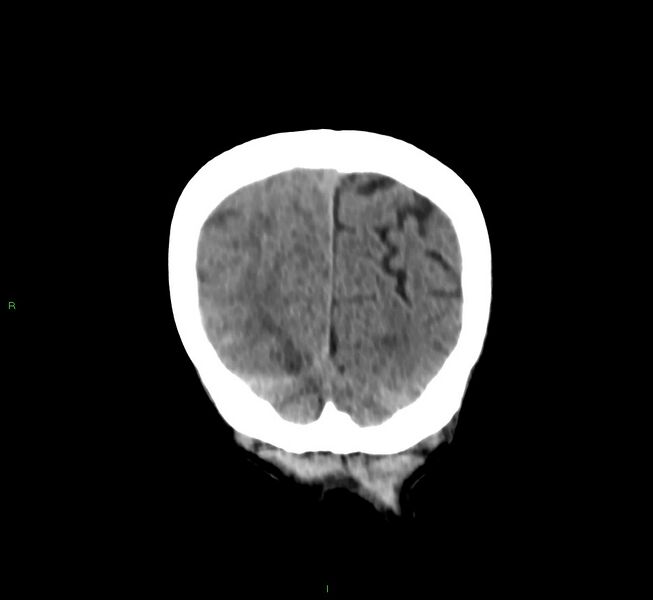 File:Cerebral amyloid angiopathy-associated lobar intracerebral hemorrhage (Radiopaedia 58758-65980 Coronal non-contrast 12).jpg
