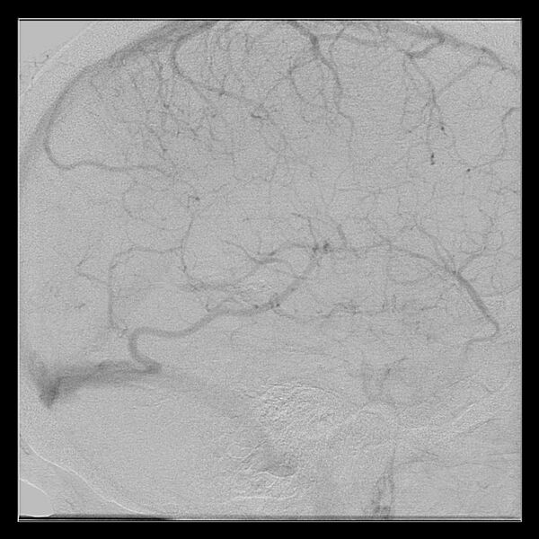 File:Cerebral aneurysm with rupture (Radiopaedia 29933-30458 LT ICA IC 48).jpg