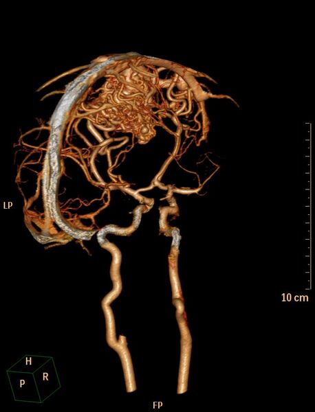 File:Cerebral arteriovenous malformation (Radiopaedia 29531-30031 B 9).jpg