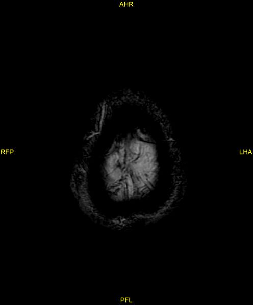 File:Cerebral autosomal dominant arteriopathy with subcortical infarcts and leukoencephalopathy (CADASIL) (Radiopaedia 86108-102054 Axial SWI 102).jpg