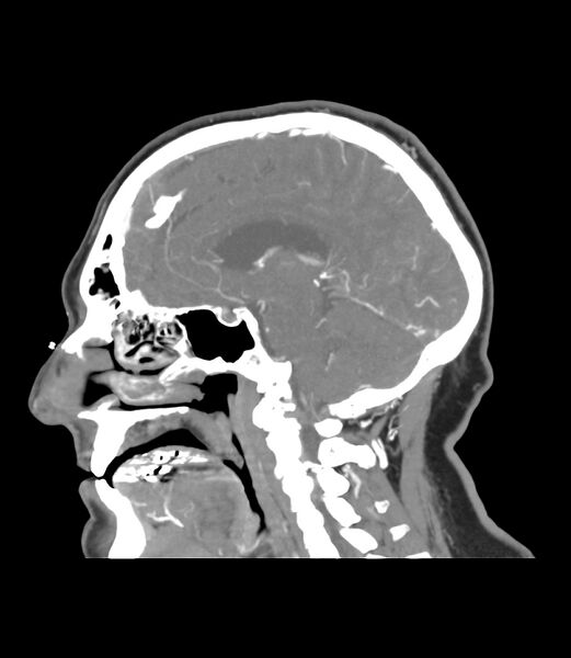 File:Cerebral dural venous sinus thrombosis (Radiopaedia 86514-102576 C 31).jpg