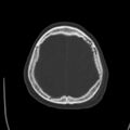 Cerebral hemorrhagic contusions (Radiopaedia 23145-23188 Axial bone window 49).jpg