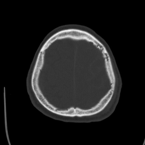 File:Cerebral hemorrhagic contusions (Radiopaedia 23145-23188 Axial bone window 49).jpg