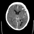 Cerebral hemorrhagic contusions (Radiopaedia 23145-23188 Axial non-contrast 21).jpg