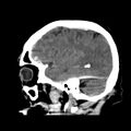 Cerebral hemorrhagic contusions (Radiopaedia 23145-23188 C 12).jpg