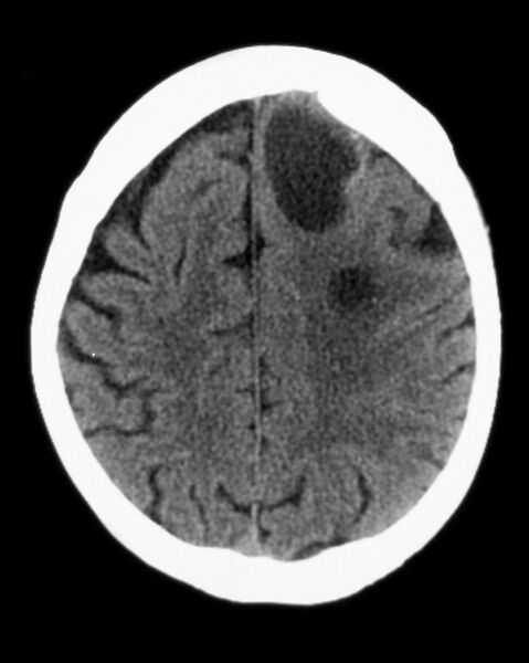File:Cerebral metastases - small cell lung cancer (Radiopaedia 3972-6522 B 1).jpg