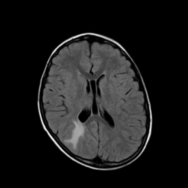 File:Cerebral tuberculoma (Radiopaedia 41152-43932 Axial FLAIR 13).jpg