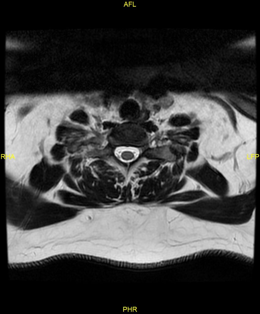 Cervical disc protrusion (Radiopaedia 87147-103415 Axial T2 69).jpg