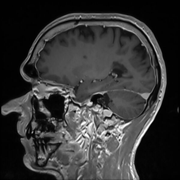 File:Cervical dural CSF leak on MRI and CT treated by blood patch (Radiopaedia 49748-54995 G 34).jpg