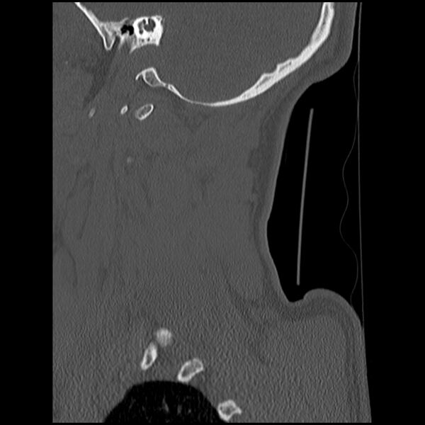 File:Cervical flexion teardrop fracture with cord hemorrhage (Radiopaedia 32497-33454 Sagittal bone window 5).jpg