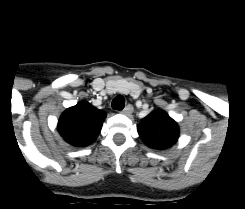 Cervical venous malformation (Radiopaedia 22653-22672 Axial C+ delayed 57).jpg