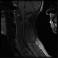 Cervical vertebrae metastasis (Radiopaedia 78814-91667 G 6).png