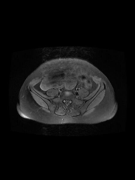 File:Cesarean section scar endometrioma (Radiopaedia 56569-63297 Axial PD fat sat 8).jpg
