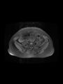 Cesarean section scar endometrioma (Radiopaedia 56569-63297 Axial PD fat sat 8).jpg