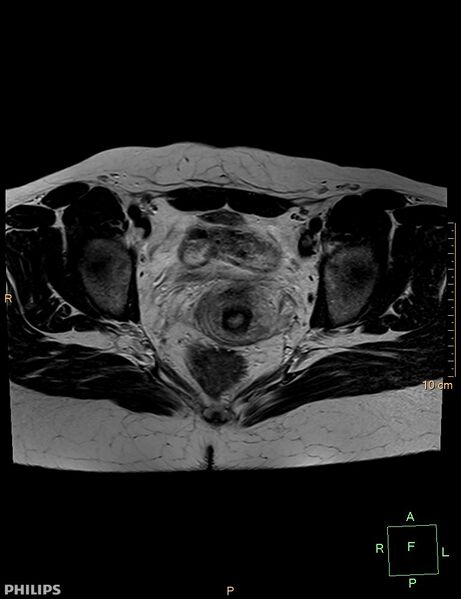 File:Cesarian scar endometriosis (Radiopaedia 68495-78066 Axial T2 16).jpg