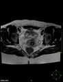 Cesarian scar endometriosis (Radiopaedia 68495-78066 Axial T2 16).jpg